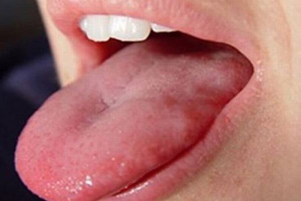 Biểu hiện không ngờ cảnh báo ung thư vòm họng cần đi khám gấp đừng nhầm lẫn với viêm họng