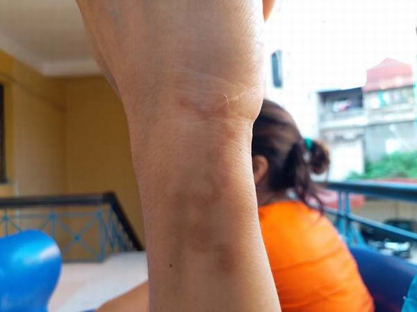 Hà Nội: Người phụ nữ thất thần khi phát hiện ấu trùng bò lổm ngổm dưới da