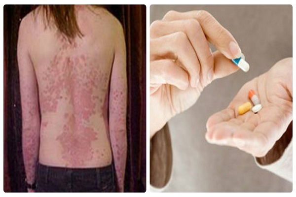 Mắc bệnh Lupus ban đỏ mà sử dụng thuốc liều lĩnh có thể gây tử vong