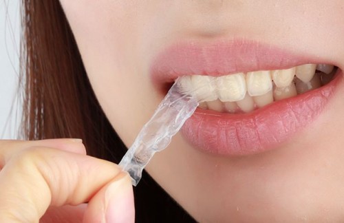 Miếng dán trắng răng dễ gây chết tủy răng, viêm loét lợi