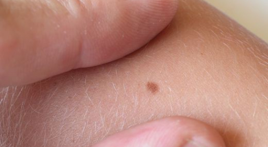 Phát hiện 'tội đồ' khiến các nốt ruồi biến thành ung thư da