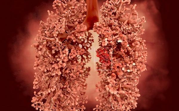 Ung thư phổi và thủ phạm gây ra căn bệnh này