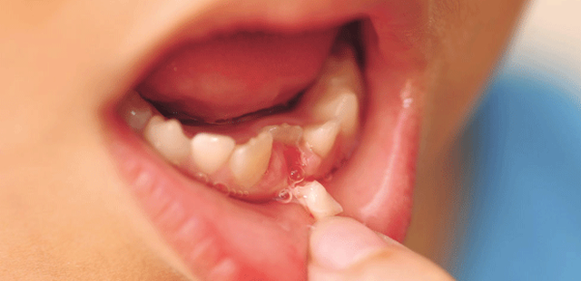  Nếu tự nhổ răng sữa tại nhà thì bố mẹ có thể bỏ qua thời điểm vàng để can thiệp nắn chỉnh, sửa chữa những lệch lạc răng vĩnh viễn ở giai đoạn sớm (Ảnh minh họa). 