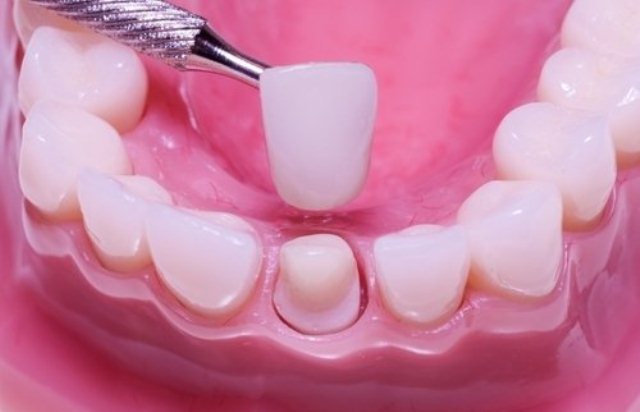 Bọc răng sứ thay đổi tướng mạo: Coi chừng viêm lợi, vỡ răng