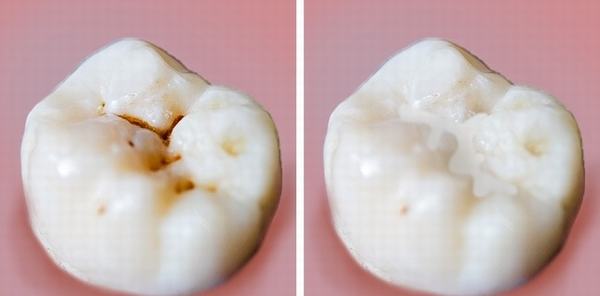 Nếu bạn phạm phải 6 thói quen này trong chăm sóc răng miệng thì cần phải loại bỏ ngay