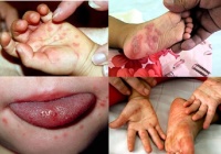 Khuyến cáo: Bệnh tay chân miệng đang 'tấn công' trẻ em không ngừng