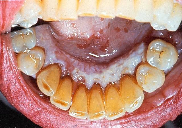 Những nguyên nhân gây nên hiện tượng lưỡi trắng - hóa ra có cả nguyên nhân nguy hiểm không ngờ