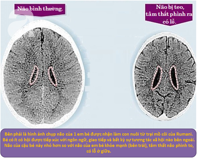 Ảnh chụp CT não của 2 em bé khác nhau khiến bố mẹ giật mình về cách dạy con