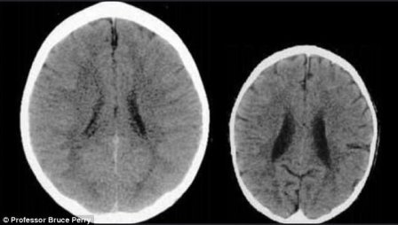Ảnh chụp CT não của 2 em bé khác nhau khiến bố mẹ giật mình về cách dạy con