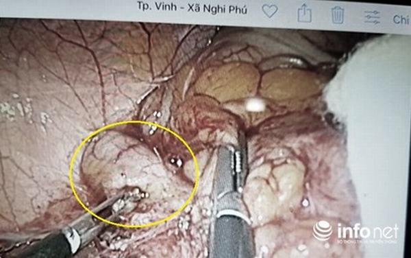 Chuyện kỳ lạ ở Nghệ An: Một bệnh nhân phải cắt ruột thừa... 2 lần