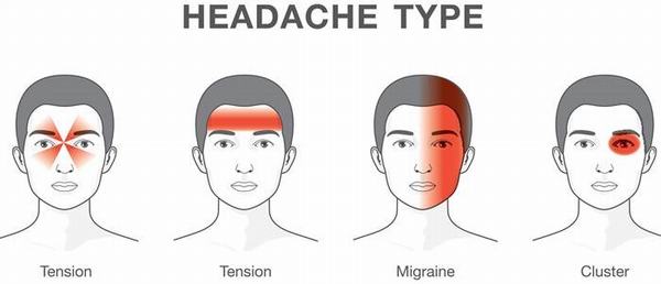 Có đến 5 loại đau đầu, bạn phân biệt được mấy loại?