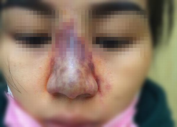 Cô gái suýt mất mũi vì tiêm filler trúng tĩnh mạch