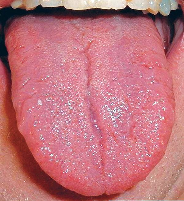 Nếu lưỡi bạn có những dấu hiệu này cần đi khám ngay lập tức kẻo 