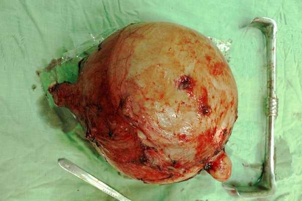 Phẫu thuật thành công khối u xơ tử cung to nặng gần 6 kg