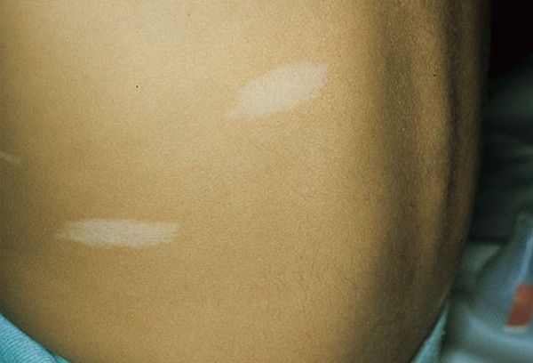 Xuất hiện những chấm trắng trên da như này, đừng chủ quan vì có thể là dấu hiệu của bệnh nguy hiểm
