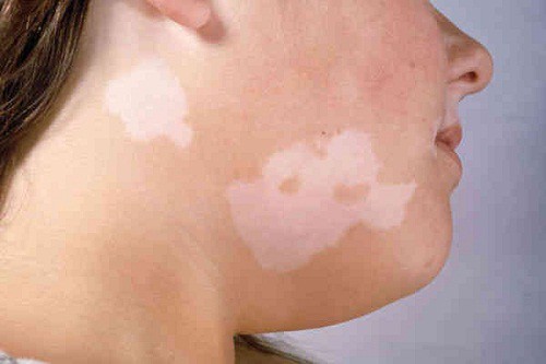 Xuất hiện những chấm trắng trên da như này, đừng chủ quan vì có thể là dấu hiệu của bệnh nguy hiểm