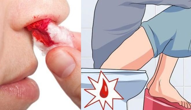 Chảy máu bất thường trên cơ thể - nguy cơ mắc trọng bệnh