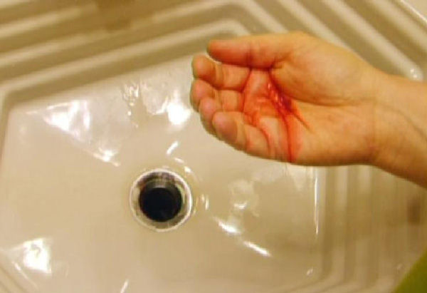 Chảy máu bất thường trên cơ thể - nguy cơ mắc trọng bệnh
