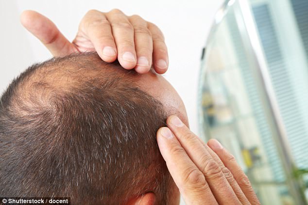 Đàn ông hói đầu, tóc bạc màu sớm có nguy cơ mắc bệnh tim cao hơn gấp 5 lần
