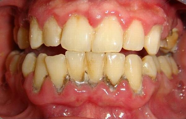 Nhai 3 viên lạc sống trong 5 phút, răng trắng như bọc sứ, cao răng cứng đầu sẽ tự bong ra, hiệu quả gấp 100 lần đến nha sĩ