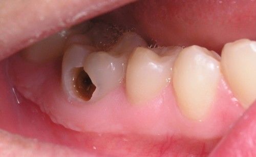 Những sai lầm ai cũng mắc khiến cho hàm răng ngày càng ố vàng