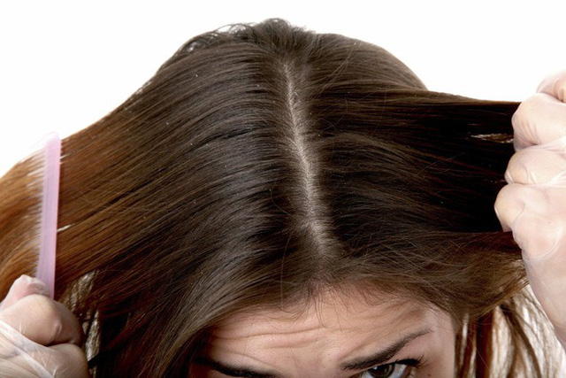 Đừng chủ quan nếu thấy tóc rụng nhiều bởi đó có thể là dấu hiệu của một vài bệnh lý nguy hiểm
