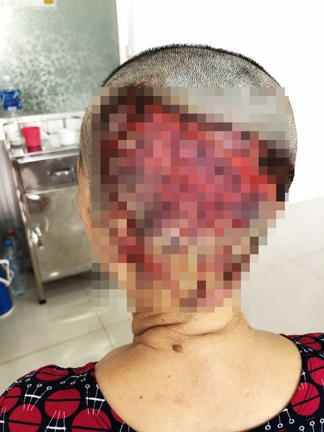 Một phụ nữ Gia Lai hoại tử da đầu nặng, vĩnh viễn không thể mọc tóc sau sự cố làm đẹp kinh hoàng