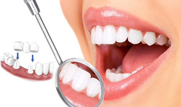 Những biến chứng đáng sợ của việc bọc răng thẩm mỹ
