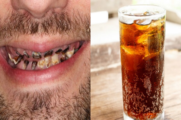 'Thối' hết cả hàm răng vì uống 'quá đà' loại nước phổ biến này