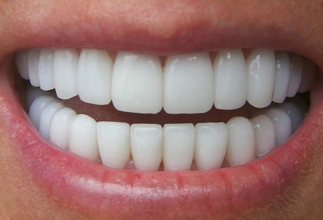 Bác sĩ BV Răng hàm mặt Trung ương chỉ rõ 3 biến chứng đáng sợ của răng sứ thẩm mỹ