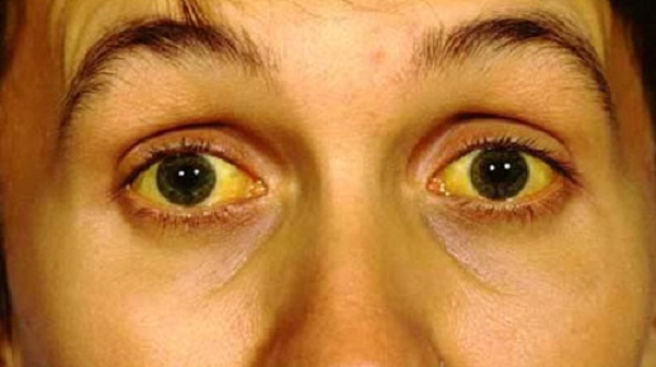 Màu mắt thay đổi bất thường có thể là dấu hiệu bệnh nguy hiểm