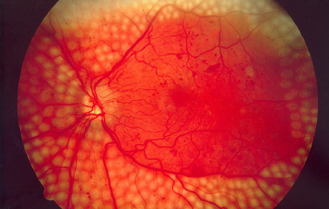 4 căn bệnh ở mắt nếu không chữa trị sớm có thể dẫn tới nguy cơ mù lòa