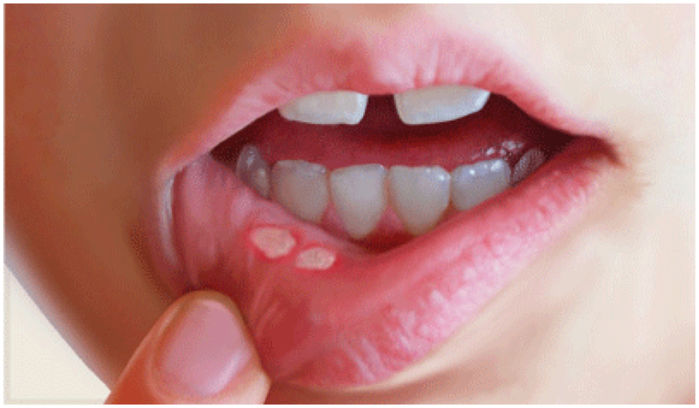 7 dấu hiệu phổ biến của bệnh ung thư miệng mà nhiều người hay bỏ qua