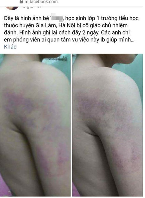 Học sinh lớp 1 ở Hà Nội bị cô giáo đánh tím người