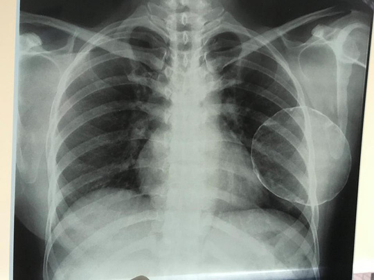 Nâng ngực bị vôi hóa, nữ Việt kiều đau đớn cầu cứu bác sĩ