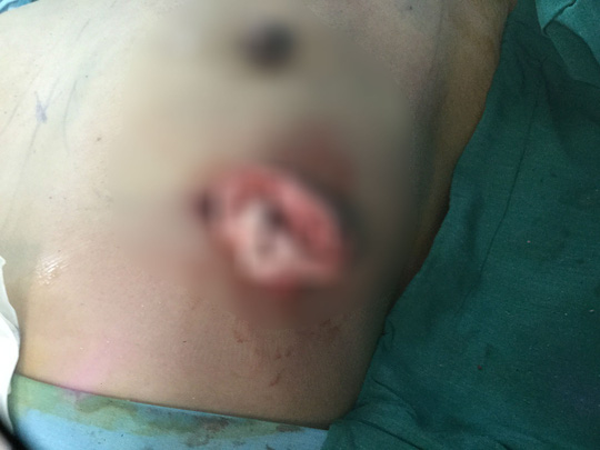 Nâng ngực bị vôi hóa, nữ Việt kiều đau đớn cầu cứu bác sĩ