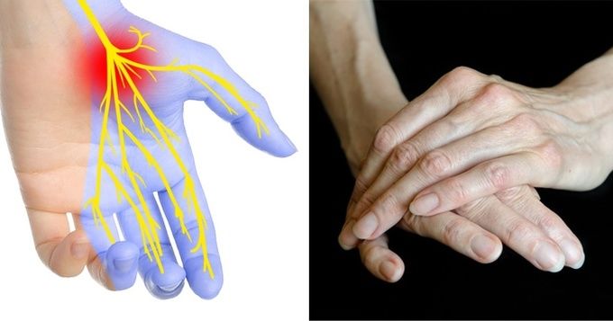 Những căn bệnh nguy hiểm được phát hiện sớm qua dấu hiệu ở bàn tay