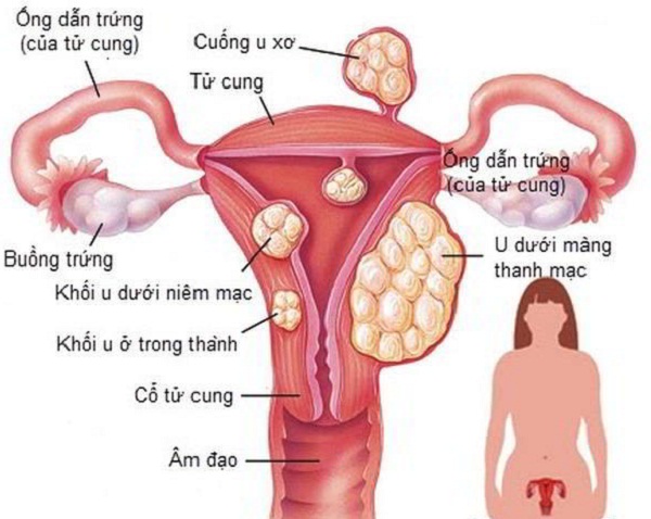 Phụ nữ trẻ tuổi: Đừng để mắc u xơ tử cung vì những món ăn quen thuộc này