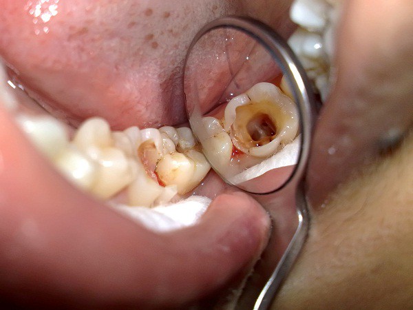 Cảnh giác với những bệnh lý răng miệng thường gặp ở phụ nữ mang thai