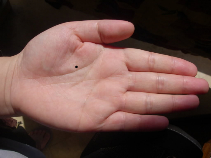 Những nốt ruồi khai vận không nên tẩy xóa vì cực kì may mắn