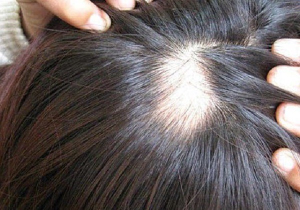 Cách đơn giản phân biệt rụng tóc bình thường và rụng tóc do bệnh lý