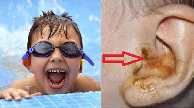 Bé gái da bong từng mảng vì nhiễm khuẩn sau khi đi bơi, 3 bước kiểm tra bể bơi sạch