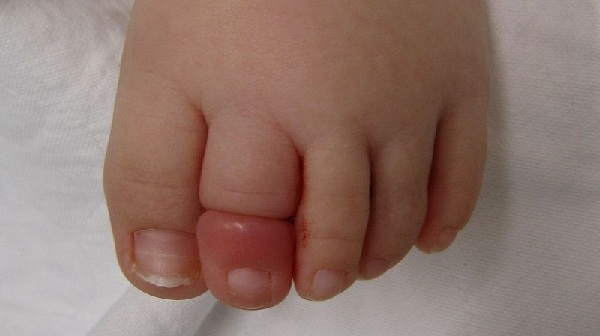 Đã có trẻ sơ sinh phải tháo khớp ngón vì bao tay, bao chân