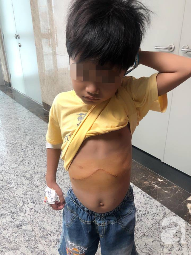 Bé trai 7 tuổi nôn ra đầy bát máu vì căn bệnh vô cùng hiểm ác