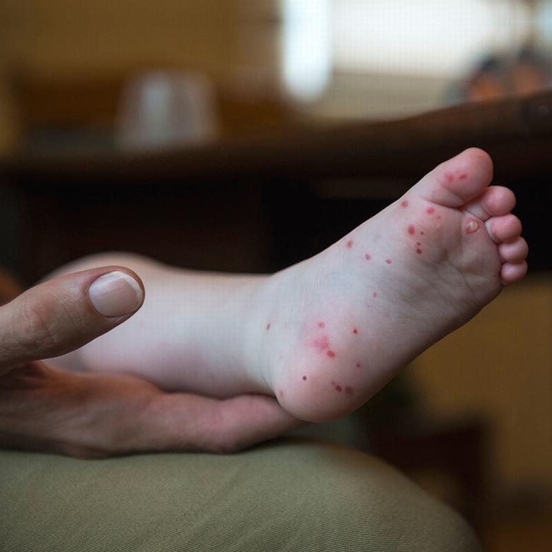 Bệnh tay chân miệng có diễn biến phức tạp vì 6 thói quen này của bố mẹ