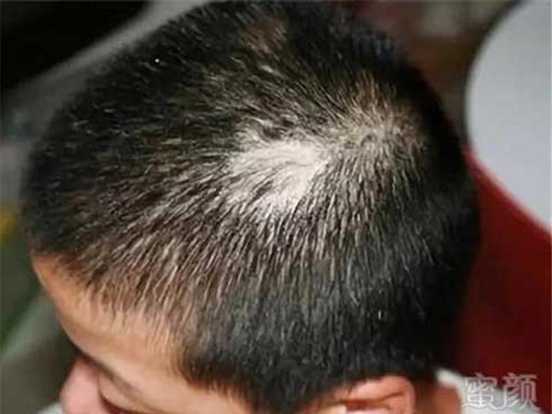 Con trai 3 tuổi đột nhiên bị rụng tóc, nguyên nhân thật sự khiến cha mẹ rất xấu hổ