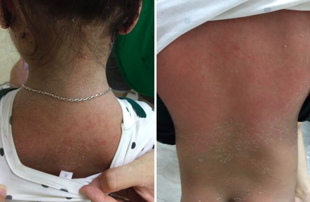 Mắc bệnh lạ, bé gái 3 tuổi ở Phú Thọ bỗng nhiên môi tều, bong tróc da toàn thân