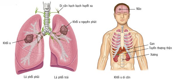 Ung thư phổi có thể di căn sang nhiều bộ phận khác trên cơ thể.