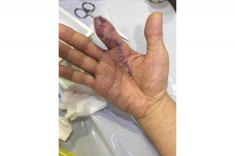 Chỉ vì sơ suất trong lúc rửa tôm, chàng trai bị viêm hoại tử phải phẫu thuật cắt bỏ một đốt ngón tay  - Ảnh 2.