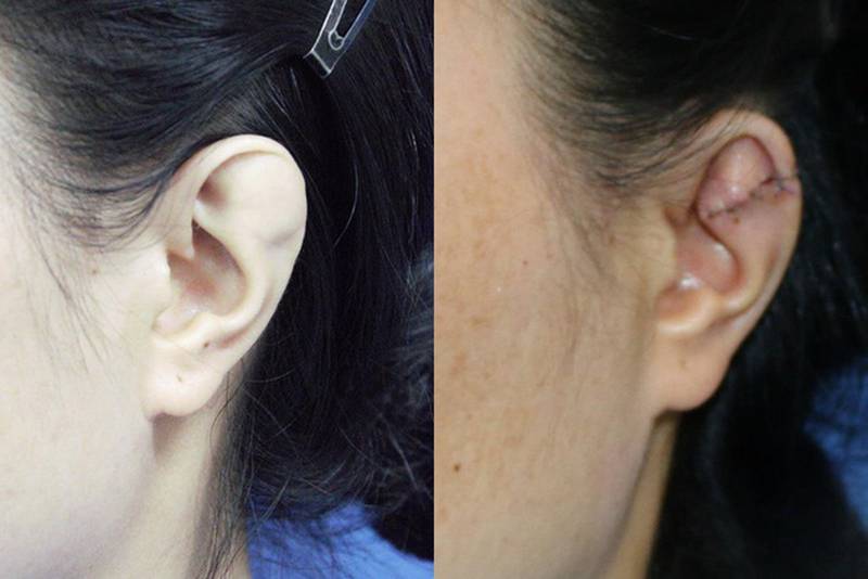 Người phụ nữ giấu chồng về đôi tai dị tật suốt 15 năm - Ảnh 1.